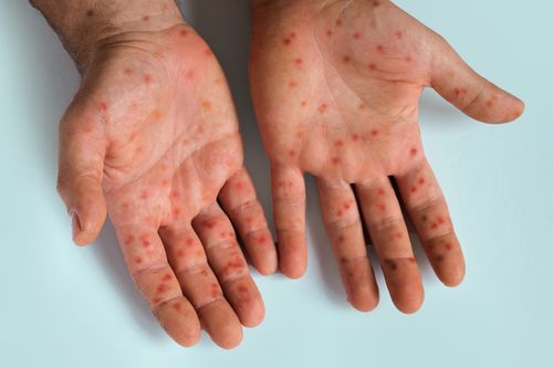 Епідемія кору — початок спалахів через низьку вакцинацію.